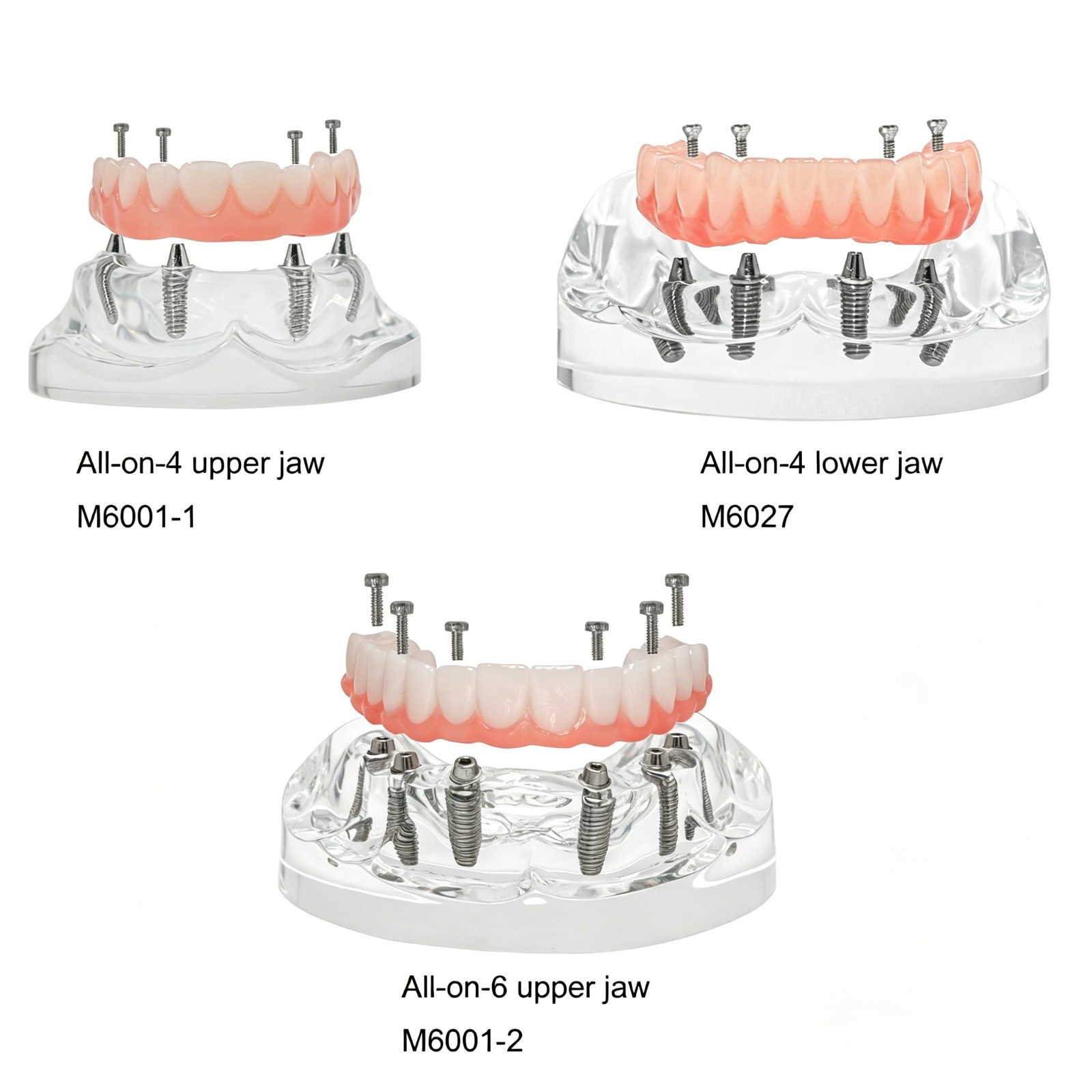 Clear Base Detachable All-on-4 /All-on-6 Overdenture Dental Implant Study Model