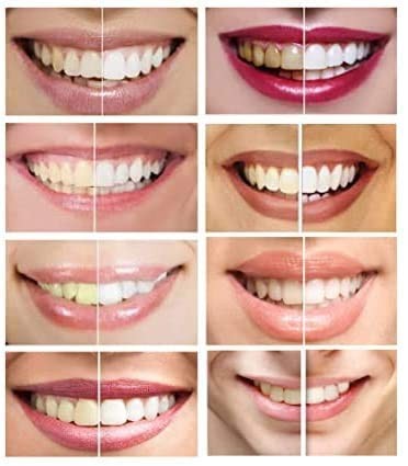 White Teeth GLobal Whitening Gel 44% Carbamide 1 Count (Pack of 1)